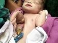 В Індії народилася дівчинка з рідкісною аномалією  -  відкритим серцем (фото, 16+)